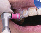 歯の表面のクリーニング