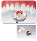 セラミックス クラウン(医療用の陶材、主にメタルに高温で陶材を焼き付けるものをいう)