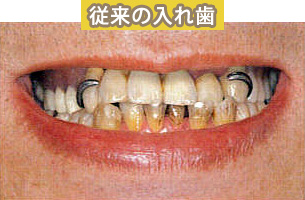 磁性アタッチメントを利用した入れ歯 施術前