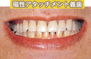 磁性アタッチメントを利用した入れ歯 施術後