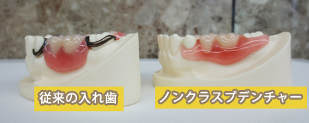 ノンクラスプデンチャー