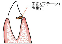 歯肉炎のイラスト